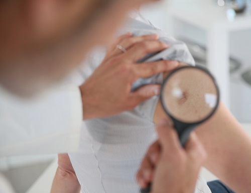doctor examines a skin mole with magnifier